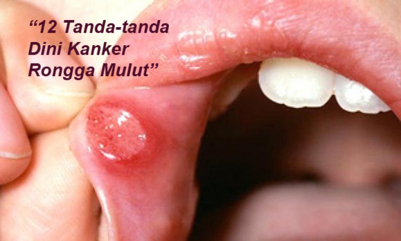 12 Tanda-tanda Dini Kanker Rongga Mulut